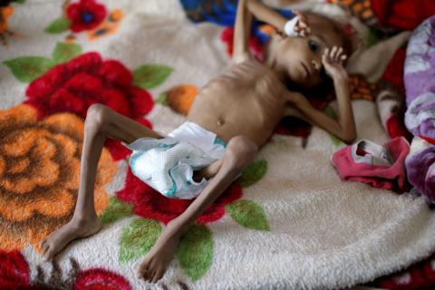 A malnourished boy lies on a bed in a malnutrition treatment centre at the al-Sabeen hospital in Sanaa, Yemen, October 6, 2018. PHOTO BY REUTERS/Khaled Abdullah