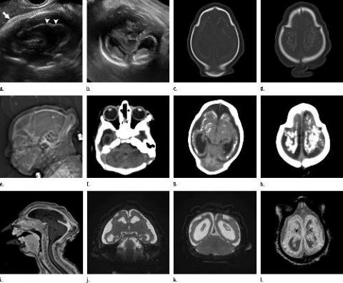 MRI images obtained in the case of an 18-year-old woman, first seen for rash at 10 weeks of pregnancy, with confirmed Zika virus infection in Northeastern Brazil. PHOTO BY REUTERS