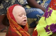 An albino child sits outside the courtroom in Ruyigi, eastern Burundi, May 28, 2009. PHOTO BY REUTERS/Jean Pierre Aime Harerimana