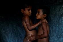 Rohingya refugees Mohamed Heron, 6, and his brother Mohamed Akter, 4, pose for a portrait to show burns on their bodies at Kutupalong refugee camp, near Cox's Bazar in Bangladesh, October 14, 2017. PHOTO BY REUTERS/Jorge Silva