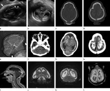 MRI images obtained in the case of an 18-year-old woman, first seen for rash at 10 weeks of pregnancy, with confirmed Zika virus infection in Northeastern Brazil. PHOTO BY REUTERS