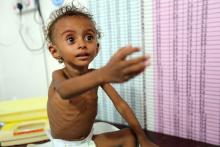 TAIZ, Yemen (Reuters) - Lying on a dust-covered bed in a hospital ward in the Yemeni city of Taiz, 10-year-old Ghazi Mohammed barely has enough energy to watch doctors and nurses examine his emaciated body.  The boy weighs 8.5 kg (18 lb), less than a third of the average weight of a child his age. He fled hunger and poverty in his mountain village last year to find only more suffering in Yemen's third largest city Taiz.  "This shows that the humanitarian aid that comes to Yemen does not reach people who rea