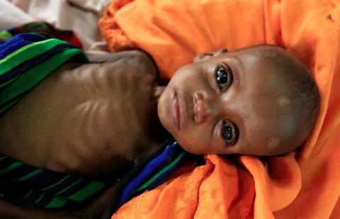 An unidentified severely malnourished Somali refugee child rests inside a ward at the Medecins Sans Frontieres (MSF) hospital at the Dagahale refugee camp in Dadaab, near the Kenya-Somalia border, in Garissa County, Kenya, July 28, 2011. PHOTO BY REUTERS/Thomas Mukoya