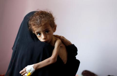 A woman holds a malnourished boy in a malnutrition treatment centre at the al-Sabeen hospital in Sanaa, Yemen, October 6, 2018. PHOTO BY REUTERS/Khaled Abdullah