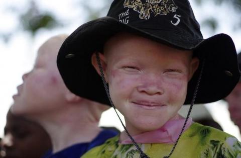 An albino girl smiles in Mitindo Primary School in Nyawilimilwa, Mwanza region of Tanzania, file. PHOTO BY REUTERS/Katrina Manson