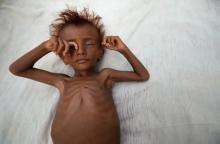 A malnourished boy lies on a bed outside his family's hut in al-Tuhaita district of the Red Sea province of Hodaida, Yemen, September 26, 2016. PHOTO BY REUTERS/Abduljabbar Zeyad