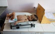 A malnourished child lies on a weighing scale at the malnutrition ward of al-Sabeen hospital in Sanaa, Yemen, September 11, 2018. PHOTO BY REUTERS/Khaled Abdullah